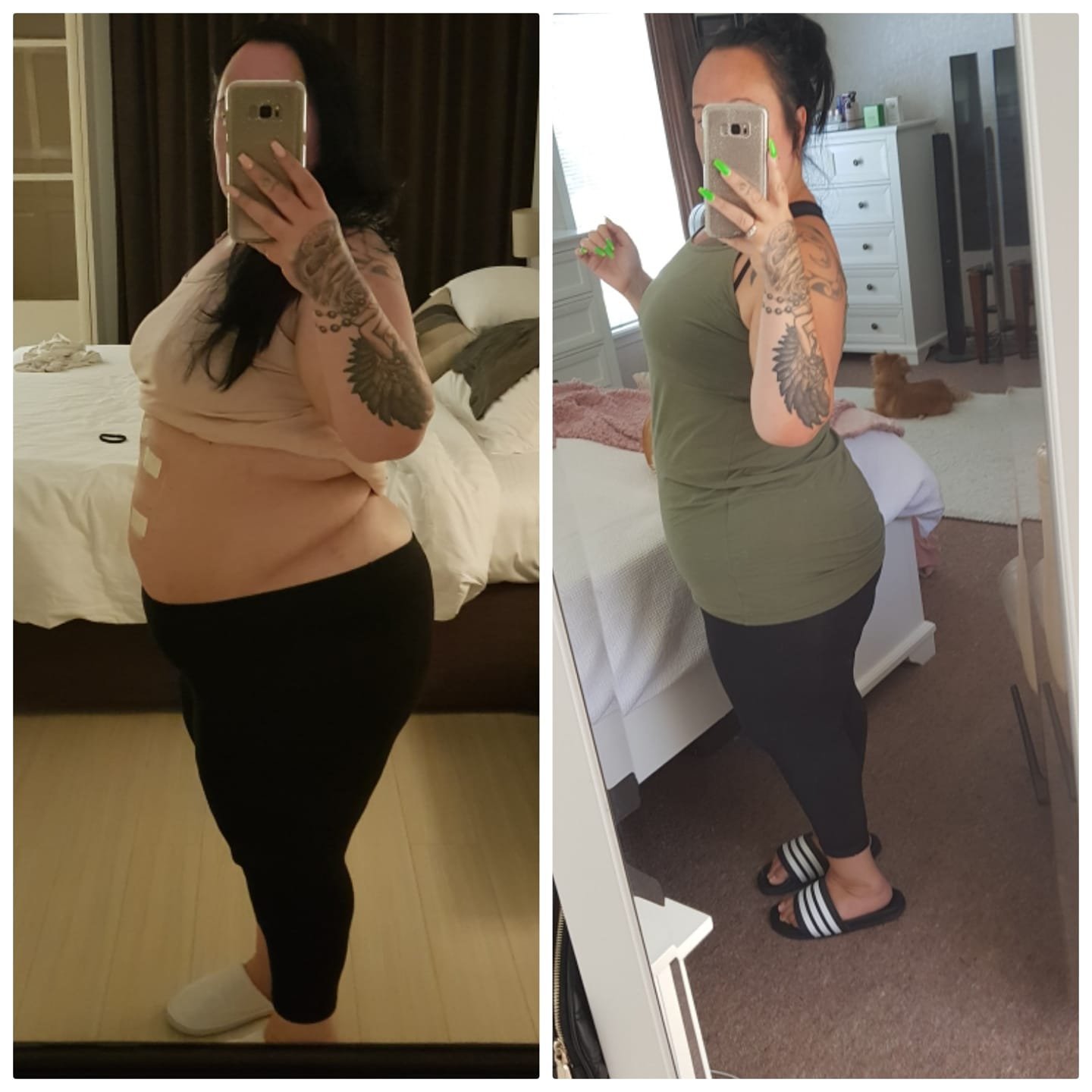 Gastric sleeve surgery in Thailand Kelly lost 30 kgs 5 month after